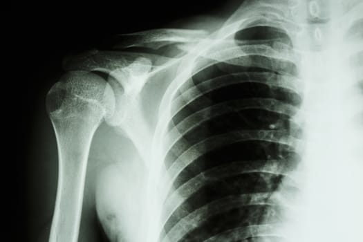 Film X-ray show fracture middle right clavicle