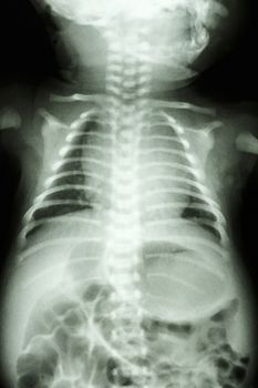film X-ray show normal chest of infant
