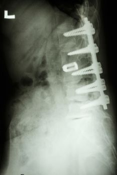 film X-ray show lumbar spine with pedicle screw fixation in spondylolithesis patient