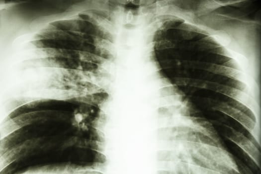 Film X-ray show patchy infiltrate at right middle lung (Lobar pneumonia)from Mycobacterium tuberculosis infection (Pulmonary tuberculosis)