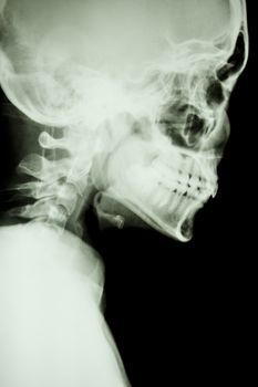 Film X-ray show normal skull and cervical spine in lateral side (isolated)