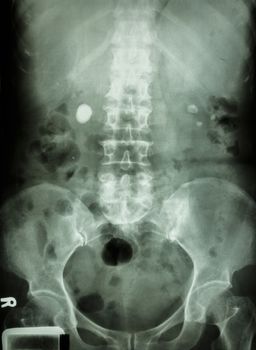 film X-ray show bilateral renal stone (round-shaped at right and left side)