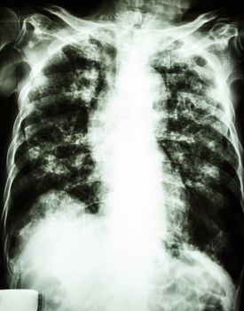 film chest x-ray show interstitial infiltrate and alveolar infiltrate both lung due to Mycobacterium tuberculosis infection (Pulmonary Tuberculosis)