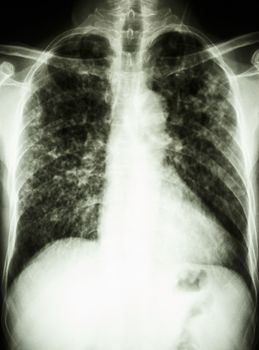 film chest x-ray show interstitial infiltrate both lung due to Mycobacterium tuberculosis infection (Pulmonary Tuberculosis)