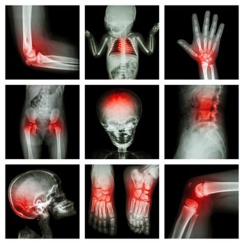 Collection X-ray part of child and multiple injury