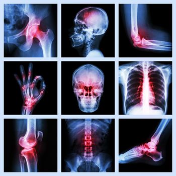 Collection X-ray and multiple injury