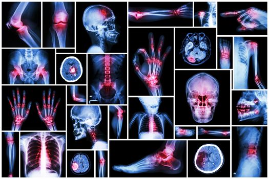 X-ray multiple part of human with multiple disease (stroke, arthritis, gout, rheumatoid, brain tumor, osteoarthritis, etc)