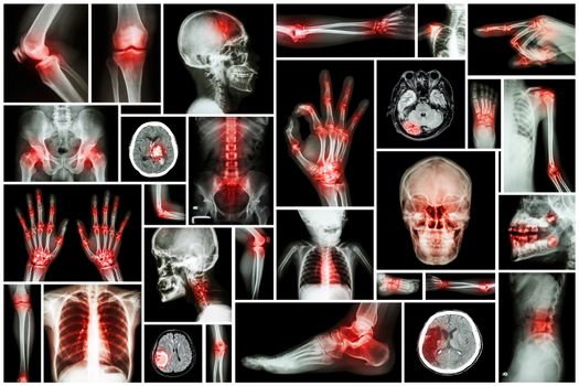 X-ray multiple part of human with multiple disease (stroke, arthritis, gout, rheumatoid, brain tumor, osteoarthritis, etc)