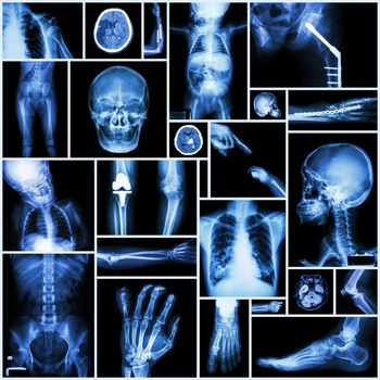 Collection X-ray "Multiple part of human" ,"Orthopedic surgery" and "Multiple disease" (Fracture,Shoulder dislocation,Osteoarthritis knee,Bronchiectasis,Lung disease,Stroke,Brain tumor, etc)