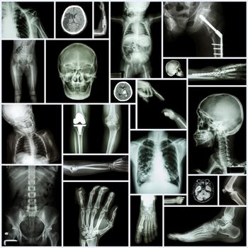 Collection X-ray "Multiple part of human" ,"Orthopedic surgery" and "Multiple disease" (Fracture,Shoulder dislocation,Osteoarthritis knee,Bronchiectasis,Lung disease,Stroke,Brain tumor, etc)