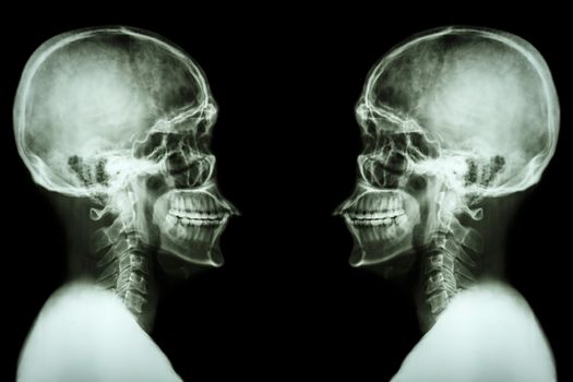 X-ray Skull and cervical spine