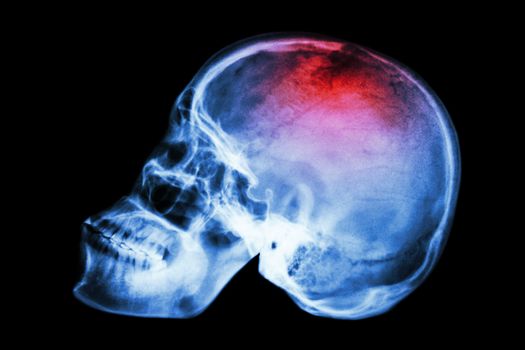 X-ray skull lateral with "Stroke"