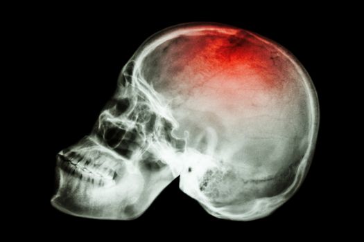 X-ray skull lateral with "Stroke"