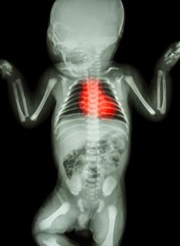 X-ray infant's body with heart disease