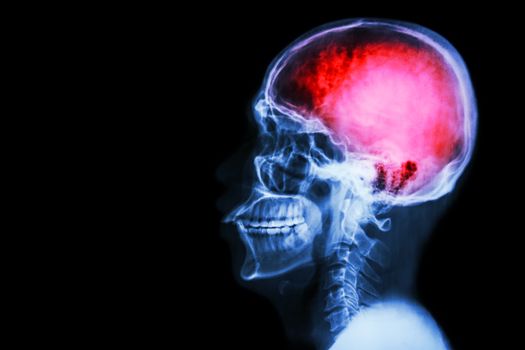 X-ray skull & cervical spine (lateral) with "Stroke"