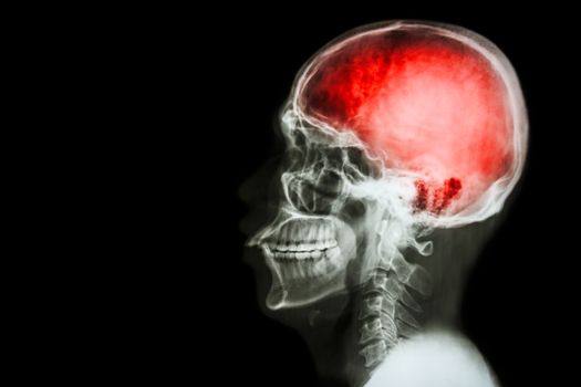 X-ray skull & cervical spine (lateral) with "Stroke"