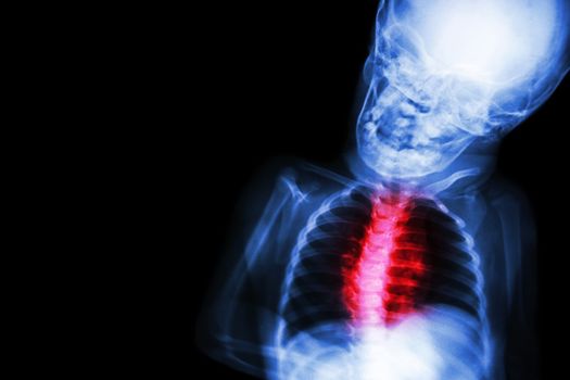 X-ray child's body with "Congenital heart disease"