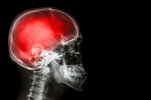 X-ray skull & cervical spine (lateral) with "Stroke"