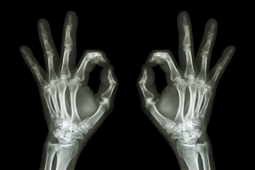 X-ray hands with OK sign