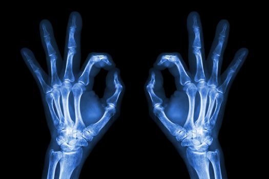 X-ray hands with OK sign