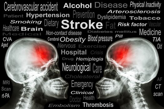 X-ray Skull with "Stroke" and Medical text