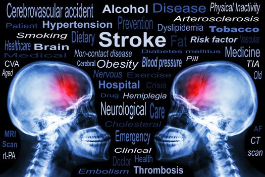 X-ray Skull with "Stroke" and Medical text