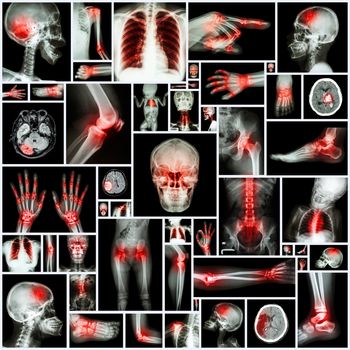 Collection X-ray multiple organ and arthritis at multiple joint (Rheumatoid,Gout)