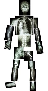 skeleton of human and multiple fracture. he was operated and internal fixed by plate and screw at multiple site