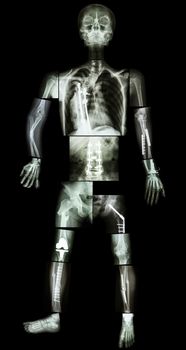 skeleton of human and multiple fracture. he was operated and internal fixed by plate and screw at multiple site