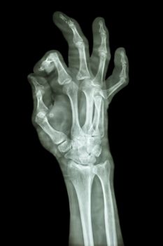 comminute fracture distal pharange of middle finger