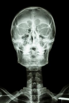 film x-ray : normal human's skull and cervical spine