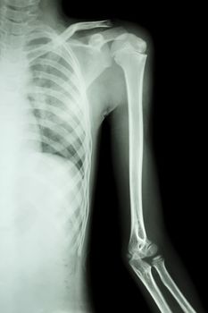 film x-ray left shoulder