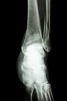 film x-ray ankle show fracture distal tibia and fibula (leg's bone)