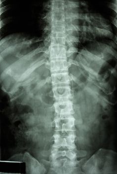 film x-ray T-L spine(Thoracic-Lumbar spine) show : normal human's thoracic-lumbar spine