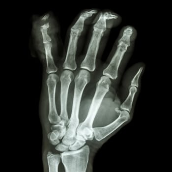 film x-ray hand AP : show fracture distal pharange little finger