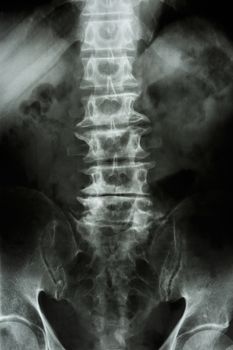 "Spondylosis" film x-ray L-S spine (lumbar-sacrum) of old aged patient