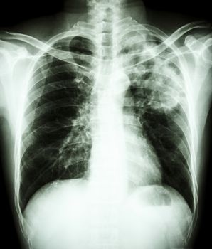film chest x-ray show alveolar infiltrate at left upper lung due to Mycobacterium tuberculosis infection (Pulmonary Tuberculosis)