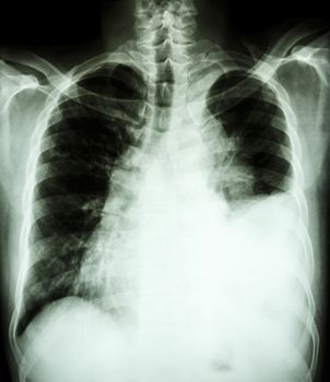 film chest X-ray PA upright : show pleural effusion at left lung due to lung cancer