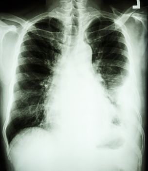 film chest X-ray PA upright : show pleural effusion at left lung due to lung cancer