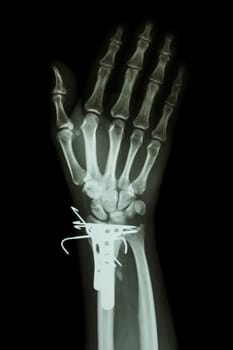 film x-ray wrist AP : show fracture distal radius (forearm's bone). It was operated and inserted plate and K-wire(Kirschner wire)