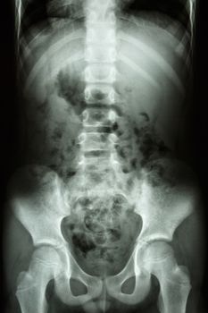 film x-ray show child's spine ,abdomen ,pelvis ,hip