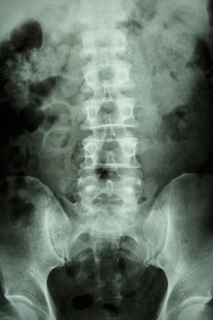 film x-ray L-S spine (lumbar-sacrum) : show normal human lumbar-sacrum spine