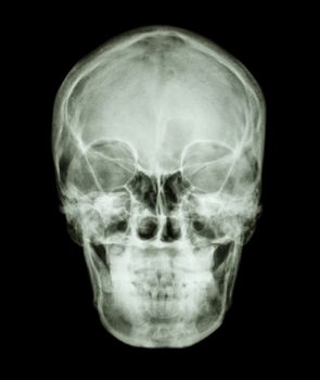 film x-ray skull AP : show normal asian human's skull (Thai people)