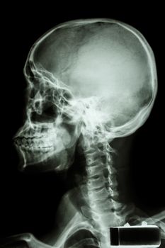 film x-ray human's skull and cervical spine