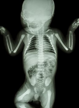 film x-ray whole infant's body