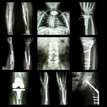 Collection of orthopedic operation