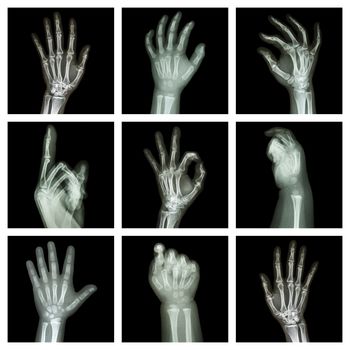 Collection x-ray of hands