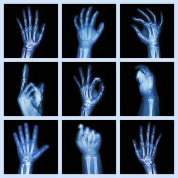 Collection x-ray of hands