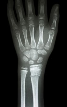 fiilm x-ray wrist show fracture distal radius (forearm's bone)