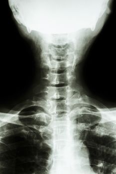film x-ray cervical spine AP : show normal thai man's cervical spine